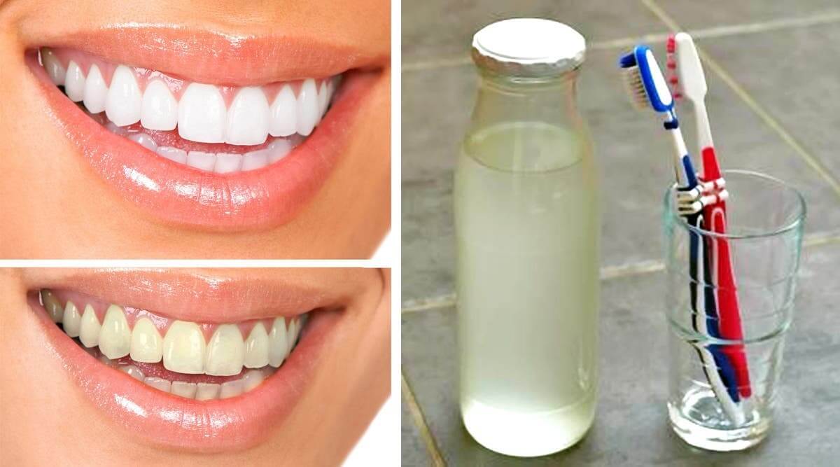 Comment faire un bain de bouche maison pour des dents plus blanches et